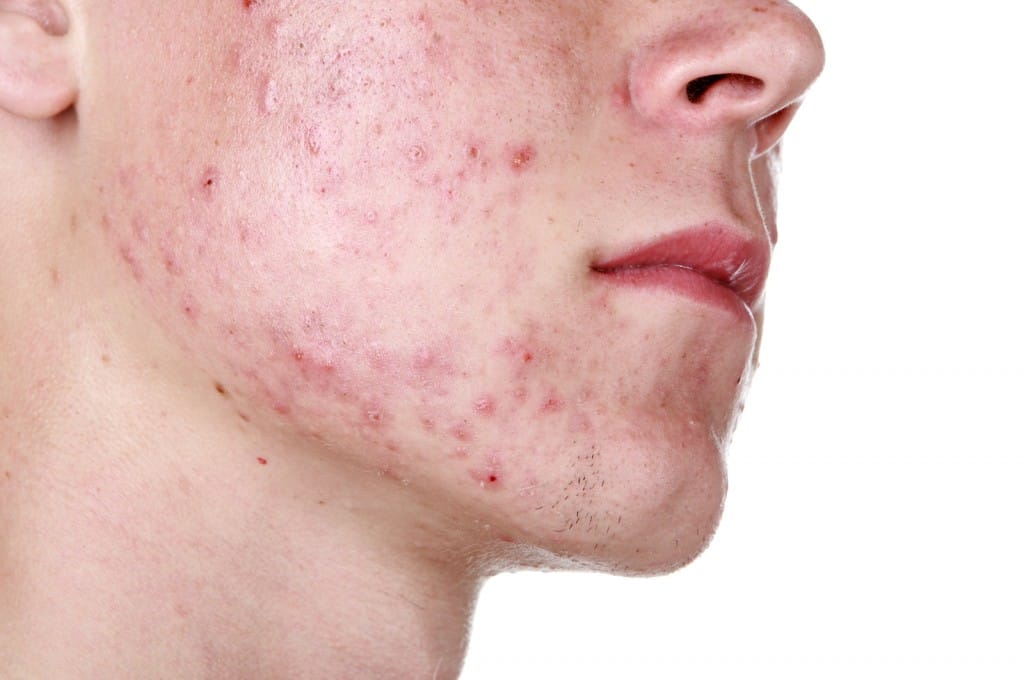 Top 10 Proven Ways To get Rid of Acne and Pimples Top 10 Proven Ways To get Rid of Acne and Pimples