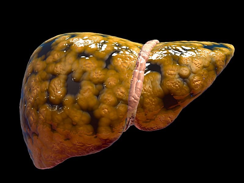 Liver Ki Beemari Ka ilaaj