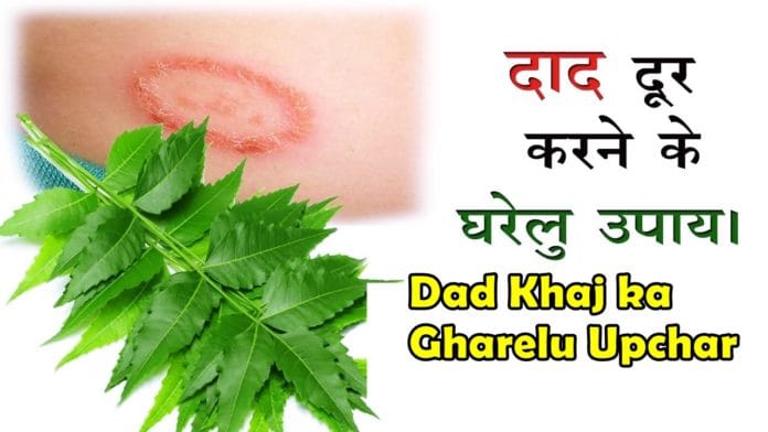 dad khaj ka gharelu upchar dad khaj ka gharelu upchar