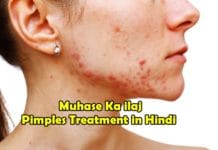 मुहासों का इलाज | Muhase Ka ilaj Pimples Treatment in Hindi Muhase Ka ilaj Pimples Treatment in Hindi