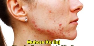 Muhase Ka ilaj Pimples Treatment in Hindi
