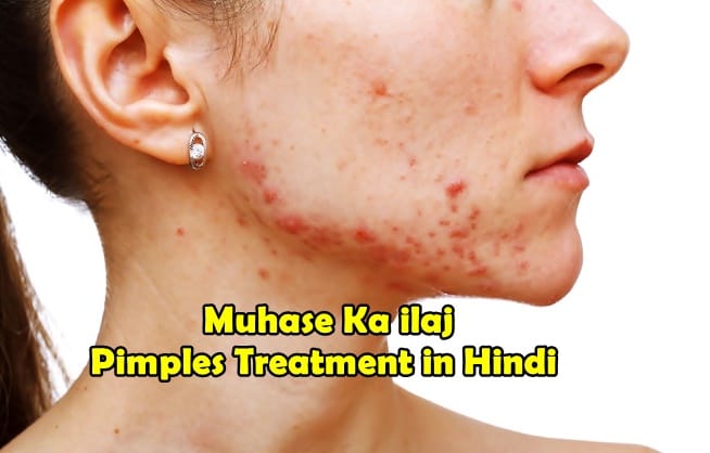 Muhase Ka ilaj Pimples Treatment in Hindi Muhase Ka ilaj Pimples Treatment in Hindi
