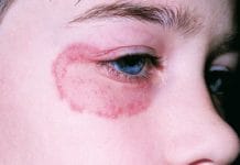 dad khaj or khujli ka gharelu upchar