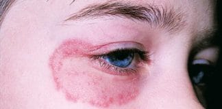 dad khaj or khujli ka gharelu upchar