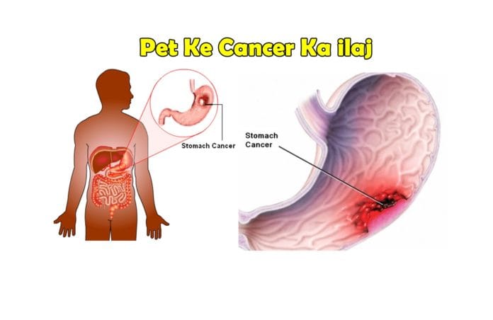 pet ke cancer ka ilaj upchar pet ke cancer ka ilaj upchar